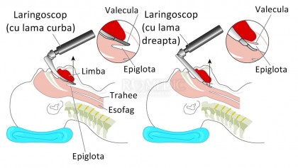 Laringoscopia