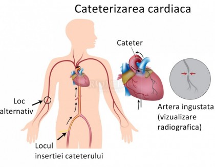 Cateterism venos central