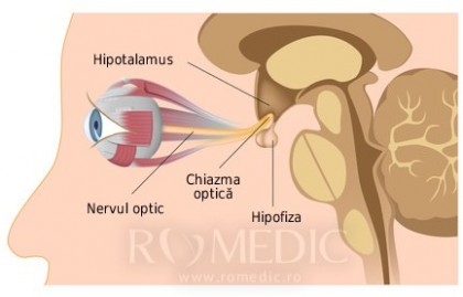 Anomaliile congenitale ale nervului optic