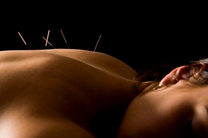 Acupunctura