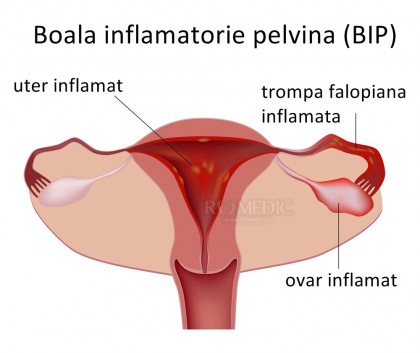 Boala inflamatorie pelvina - BIP