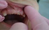 Carii severe cu distructia totala a coroanei dentare si complicata cu gangrena dentara.