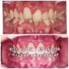 Caz 3 - Aparat dentar metalic - DentArbre - Bucuresti - sector 2 (Inainte si in cursul tratamentului ortodontic) 