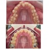 Caz 3 - Aparat dentar metalic - DentArbre - Bucuresti - sector 2 (Inainte si in cursul tratamentului ortodontic) 