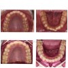 Caz 1 - Aparat Dentar Metalic - DentArbre - Bucuresti - sector 2 (inainte & dupa tratament)