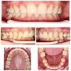 Caz 2 - Aparat Dentar Metalic - DentArbre - Bucuresti - sector 2 (inainte si dupa tratament)