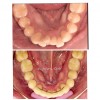Caz 3 - Poza inainte si dupa aparat dentar metalic - DentArbre - Bucuresti - sector 2