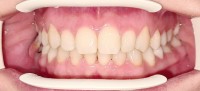 Caz 5 - Aparat Dentar Metalic - DentArbre - Bucuresti - sector 2 (dupa tratament)