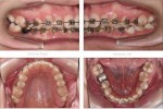 Caz 5 - Aparat Dentar Metalic - DentArbre - Bucuresti - sector 2 (inainte de tratament)