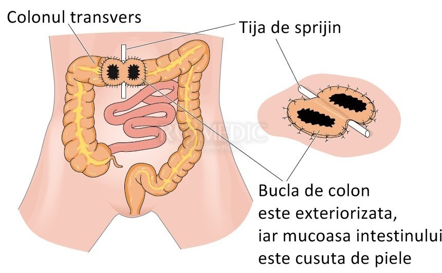 Simptomele includ constipația de pierdere în greutate. Colon iritabil