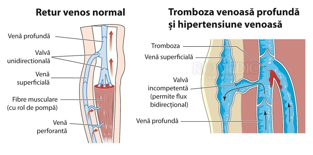 Varicoza picioare nutriie, Nutriție cu dietă varicoasă