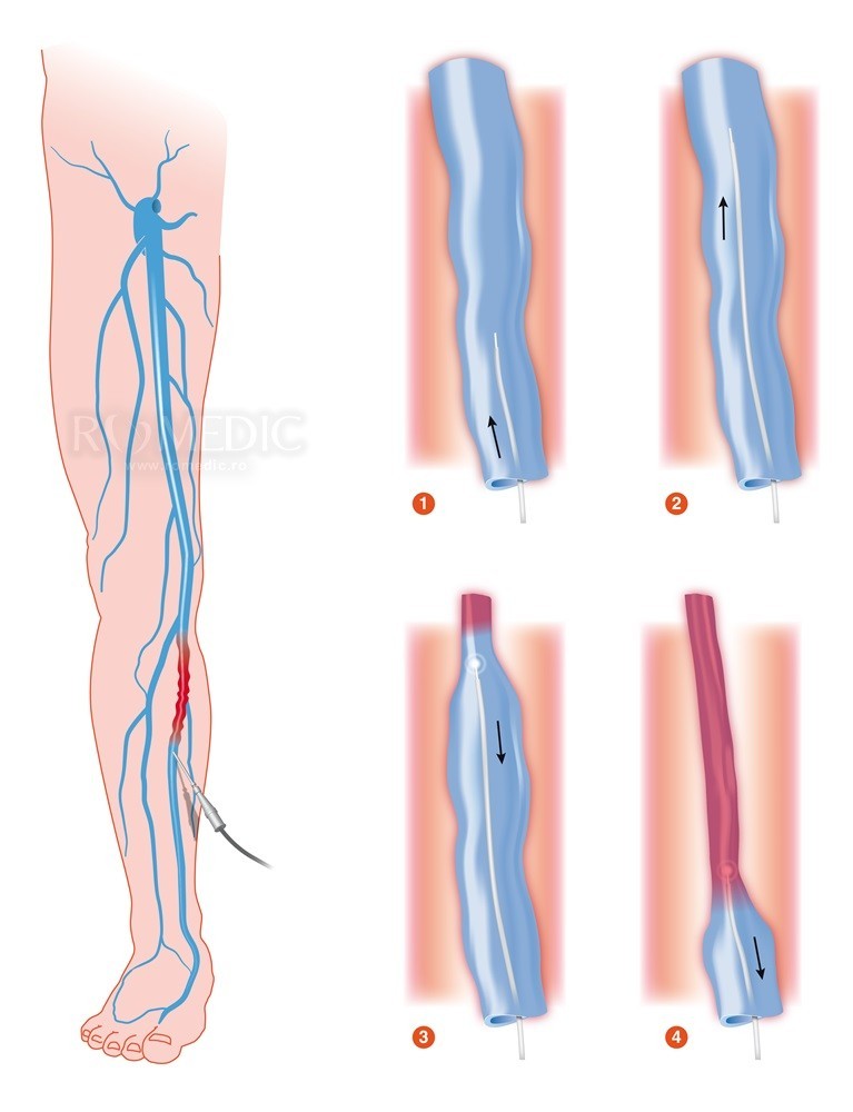 ceea ce este imposibil în variganele extremitailor inferioare