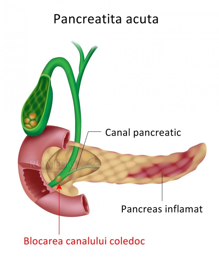 Pancreas și dureri de spate