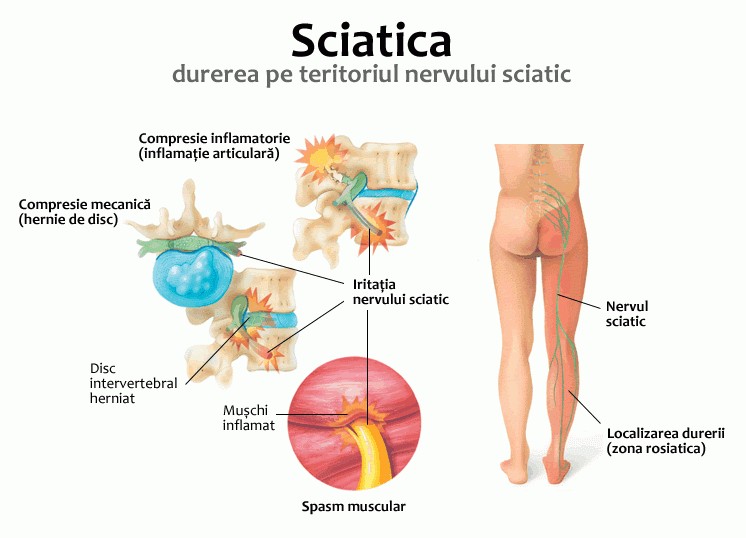 dureri nervoase sciatice înțepate în articulația genunchiului