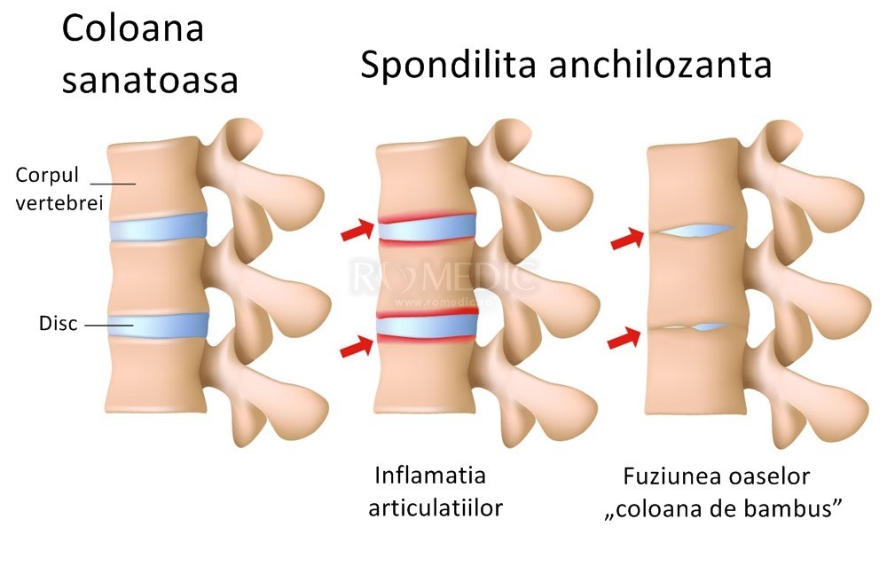 coloana vertebrală a durerii articulare