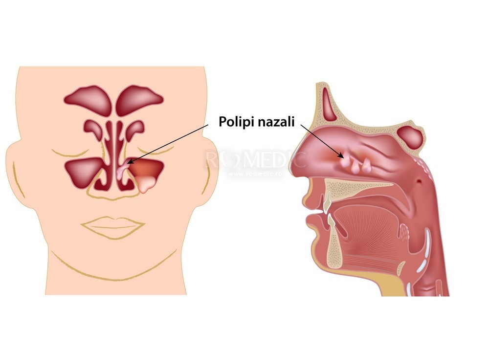 inflamația țesutului cartilaginos al aripilor nasului băi pentru ierburi pentru dureri articulare