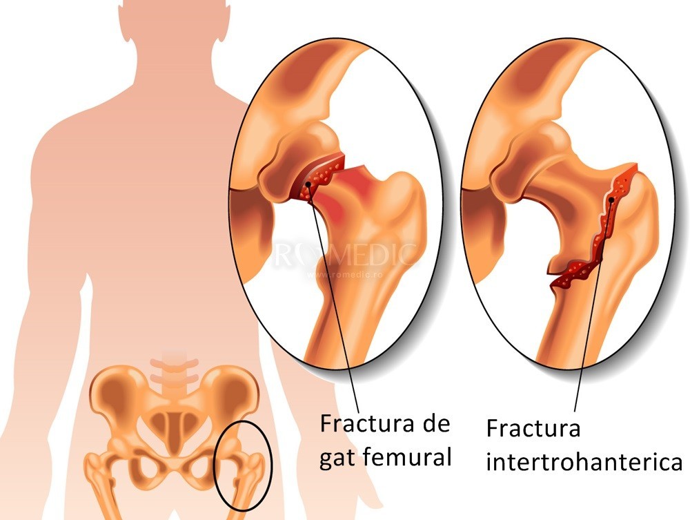 osteochondroza durerii în articulația șoldului)