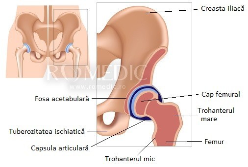 Coxartroza: cauze, simptome si metode de tratament