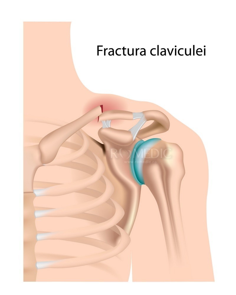 tratament articular la nivelul umerilor)