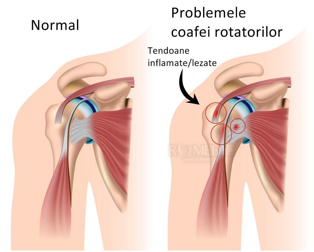 dieta alimentara cruda si dureri articulare leziune articulară clavicular acromială