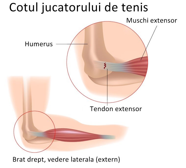 Articulatia cotului – normal vs. patologic