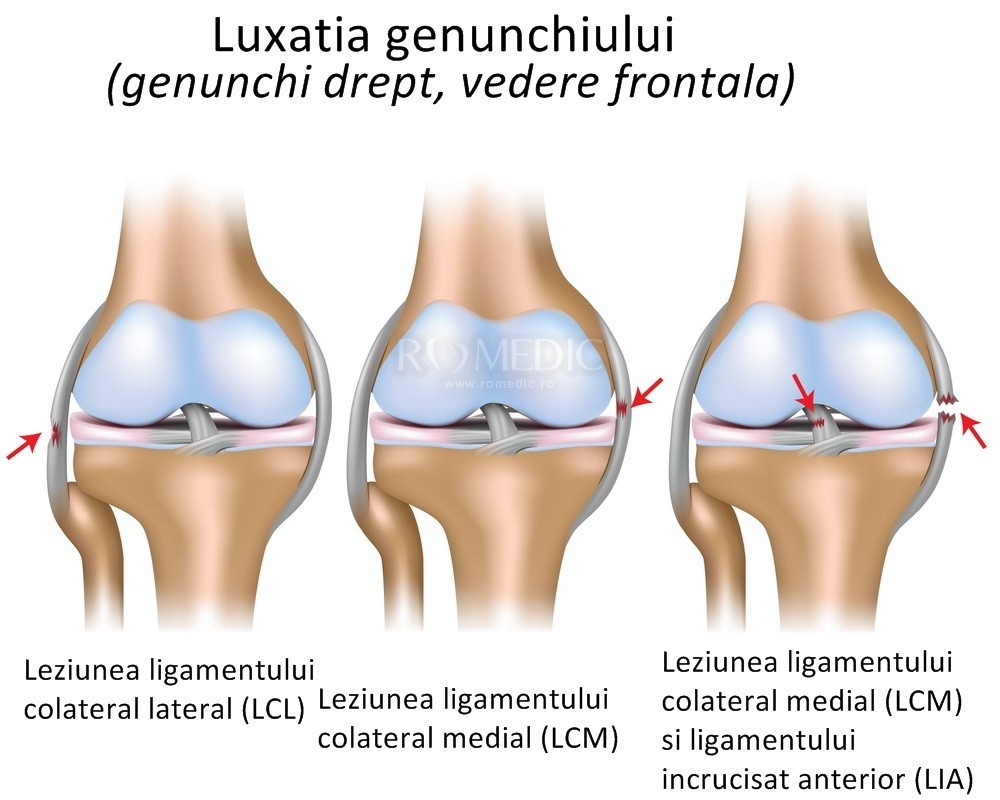 deteriorarea ligamentului lateral al articulației genunchiului stâng)