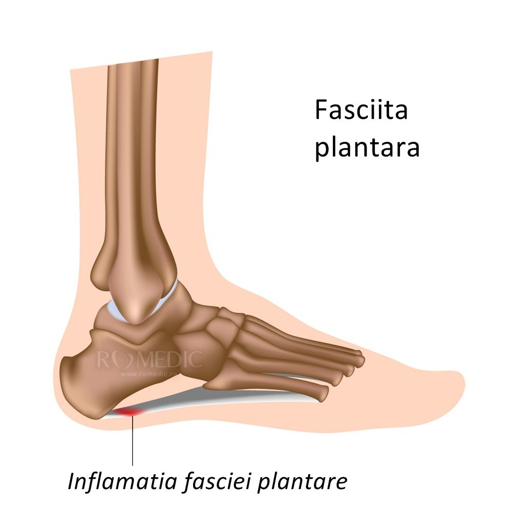 varicoza indoevazin