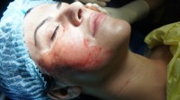 chirurgie estetica - terapia vampir - PRP pentru reintinerire faciala si estomparea cearcanelor