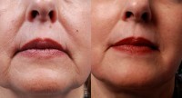 CHIRURGIE ESTETICA - PLASMOGEL - FILLER NATURAL!