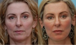 CHIRURGIE ESTETICA - BOTOX- ACID HIALURONIC- PRP- LIFTING CU FIRE- MEZOTERAPIE - OXYJET- PLASMOGEL- OFERTE- 0040722532299; 021/2112998; www.klarabancila.ro