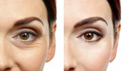 Blefaroplastia reconstructiva – vezi si arati bine!