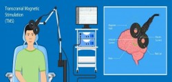 STIMULARE MAGNETICA TRANSCRANIANA