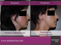 caz8 rinoplastie