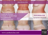 lipoaspiratie