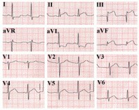 Electrocardiograma