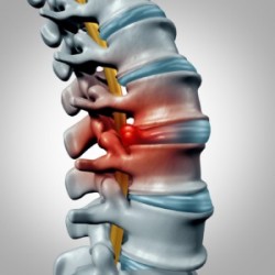 Măsurarea şi optimizarea echilibrului şi funcţionalităţii musculo-articulare a coloanei vertebrale utilizând ca parametru lucrul mecanic – Tehnologia BackFix