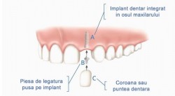 Implantologie la clinica Ina Dent