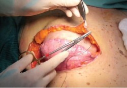 video: sub-muscular breast reconstruction_you tube/decomed channel