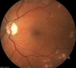 Retinopatia diabetica