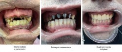 Studiu de caz: refacere majoră dentară cu înălțarea ocluziei