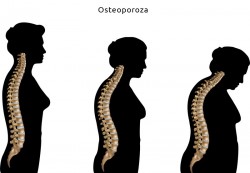 Prevenția Osteoporozei-osteodensitometrie DEXA vs REMS