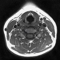 iRM Regiune Cervicala (Gât)