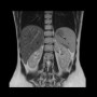 RMN Abdominal