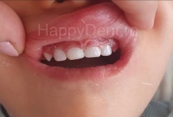 Reconstrucția dentară la copii: cazul unui mic pacient de 1 an și 9 luni