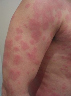 URTICARIA