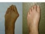 Hallux valgus (monturi)