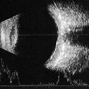 Ecografie oculara/Ocular Ultrasound