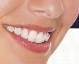 Reduceri medicale: Reducere la aparate ortodontice fixe ceramice