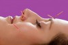 acupunctura cosmetica