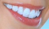 DentaCare Cluj ortodont cluj aparat ortodontic safir ortodontie cluj